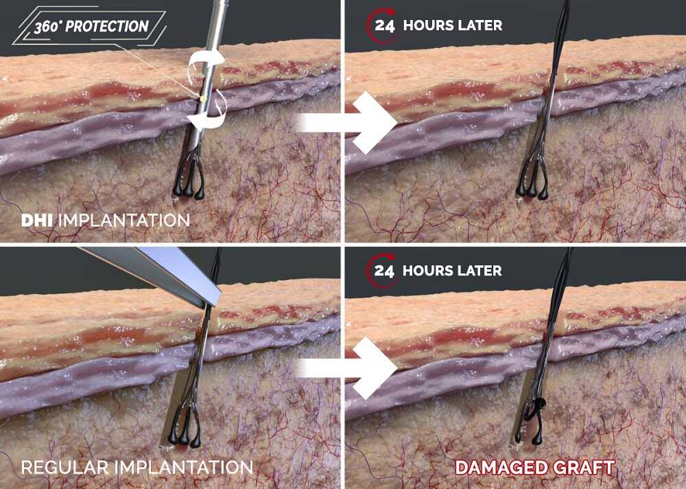 Micro sapphire dhi vs FUE transplantation process infographic