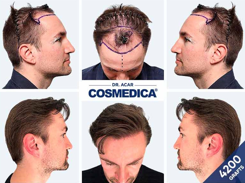 Hair Transplant Turkey Result with 4200 Grafts