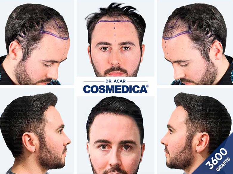 Hair Transplant Turkey Result with 3600 Grafts