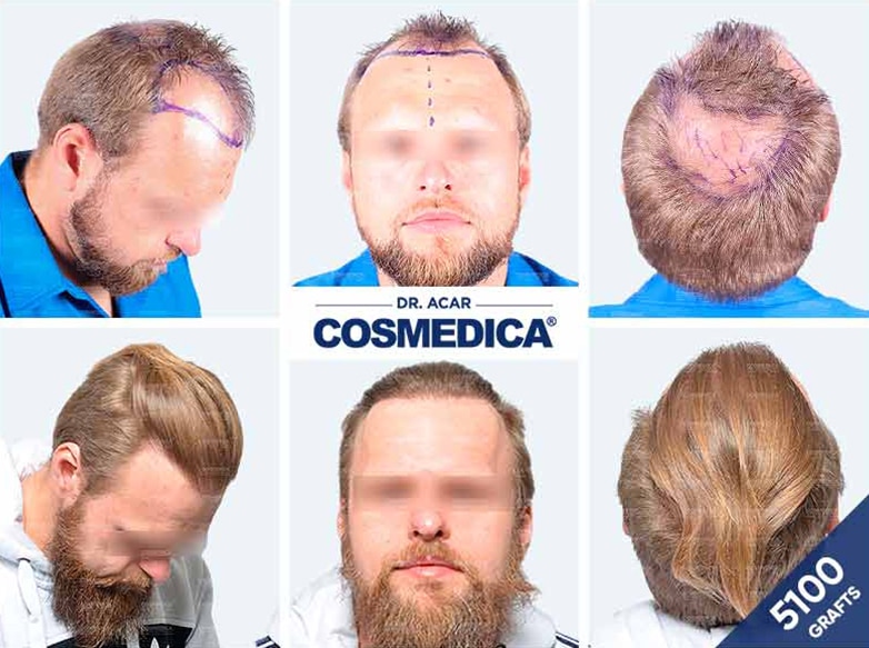 Hair Transplant Turkey Result with 5100 Grafts