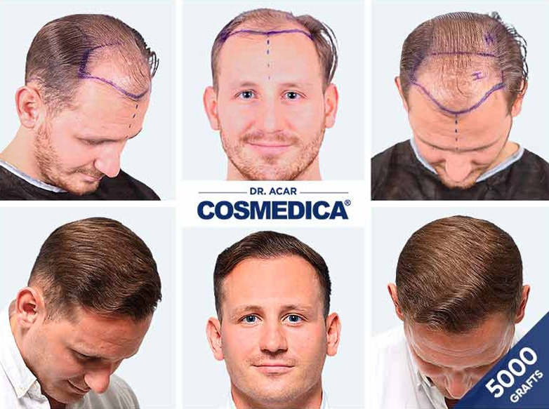 Hair Transplant Turkey before after 5000 Grafts