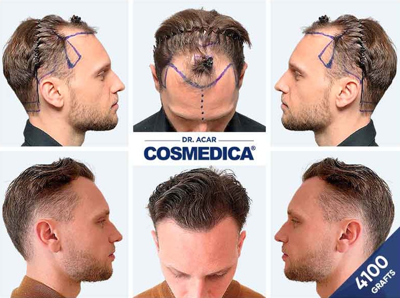 Hair Transplant in Turkey with 4100 Grafts