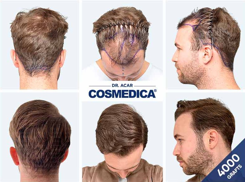 Hair Transplant Turkey Result with 4000 Grafts